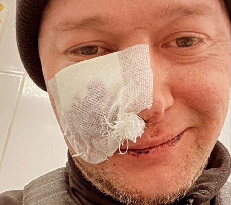Фронтмен «Бумбоксу» Андрій Хливнюк поранений під час мінометного обстрілу
