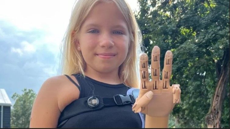 Дев'ятирічна Саша Філіпчук з Гостомеля отримала унікальний протез у США