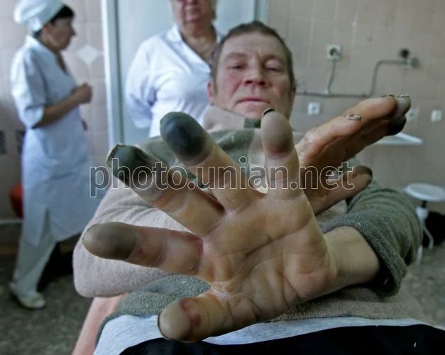 Понад 1,4 тисячі українців за місяць були госпіталізовані через обмороження та переохолодження.